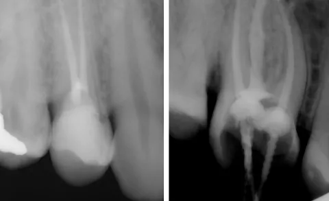Zdravljenje zobnih korenin - endodontija