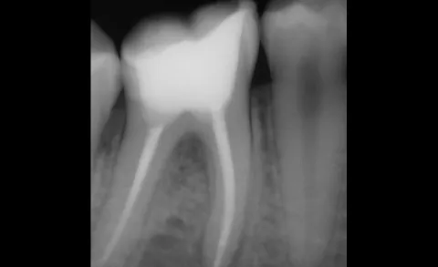 Zdravljenje zobnih korenin - endodontija